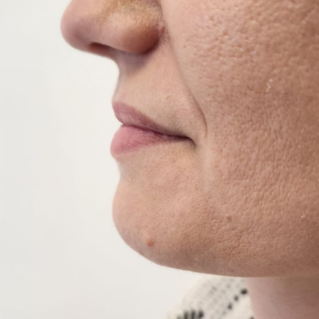 injectare acid hialuronic cluj before after - Before