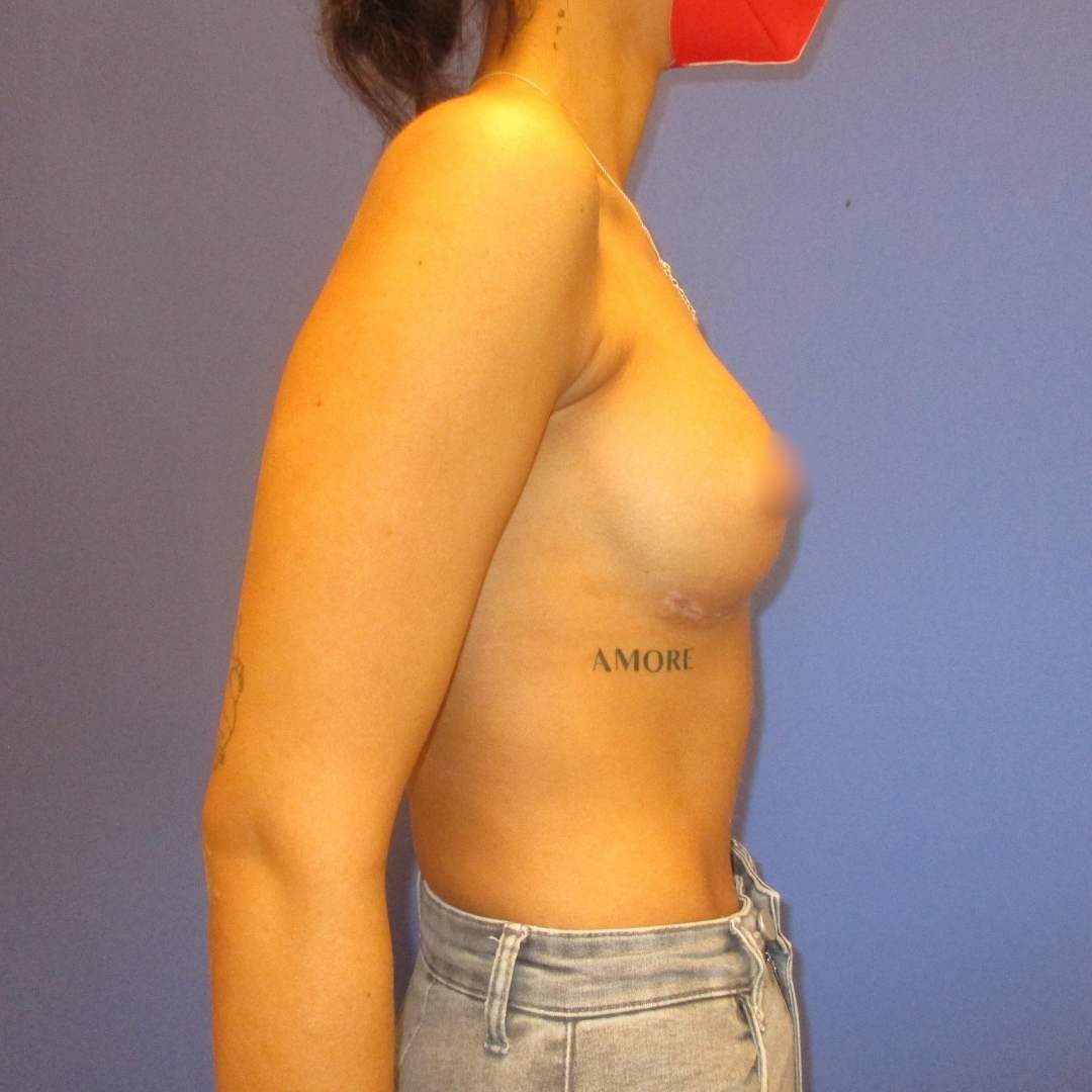 implant mamar inainte si dupa - After