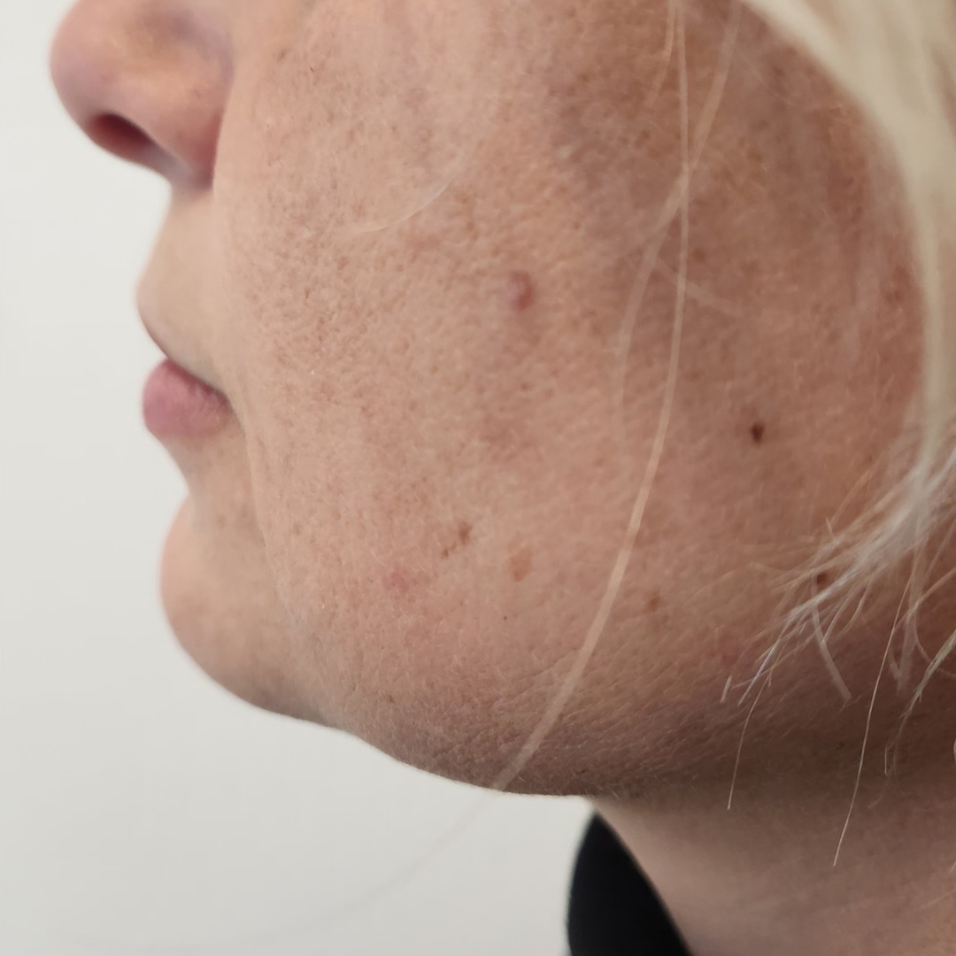 injectare acid hialuronic inainte si dupa - Before