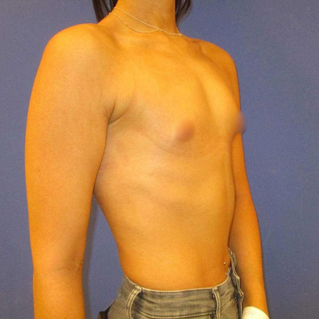 operatie implant mamar - Before