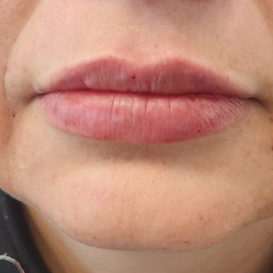 injectare acid hialuronic before after - After