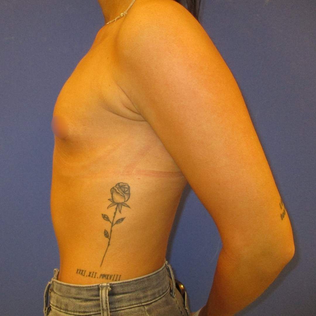 implant mamar - Before