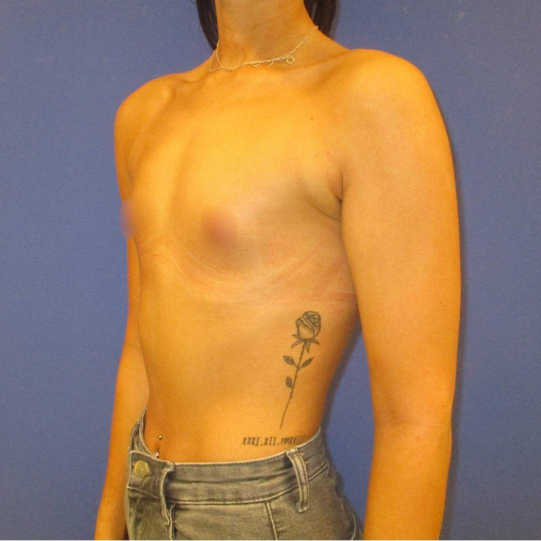 implant mamar - Before