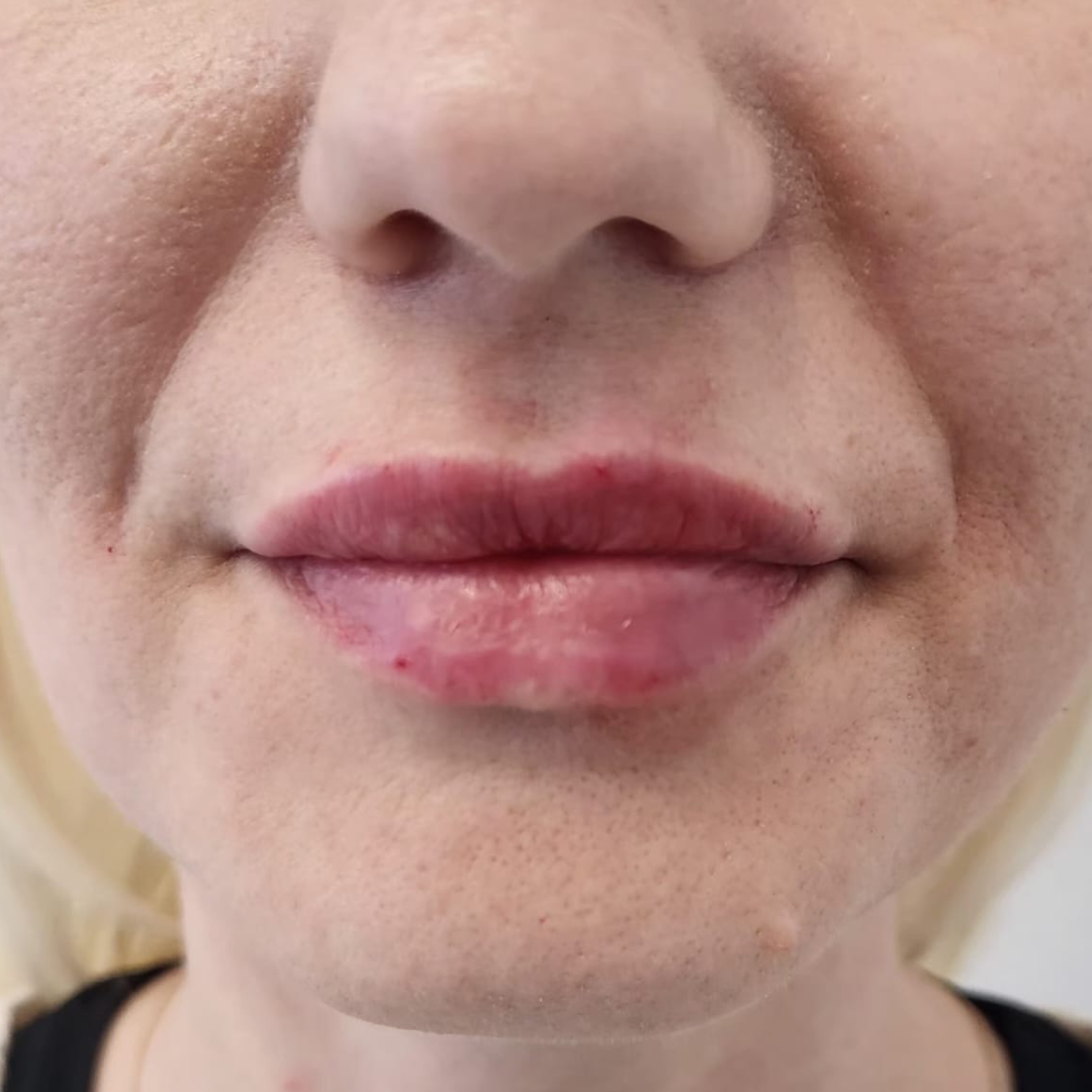 injectare acid hialuronic cluj inainte si dupa - After
