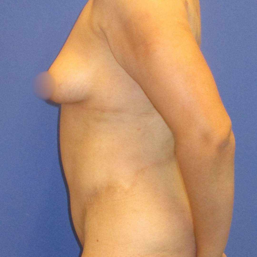 abdominoplastie inainte si dupa - After