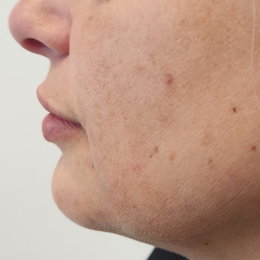 injectare acid hialuronic inainte si dupa - After