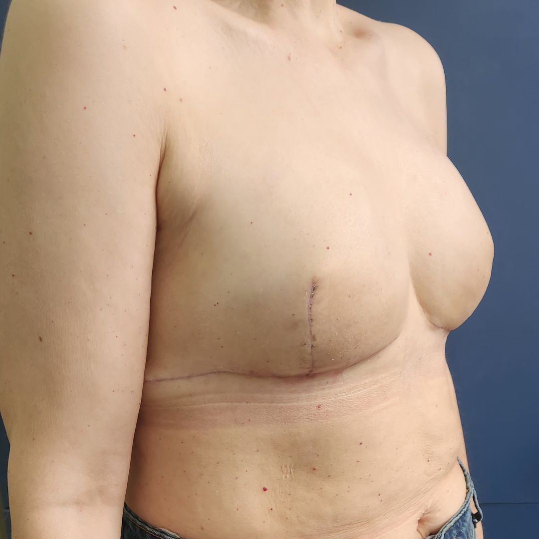 reconstructie mamara before after - After