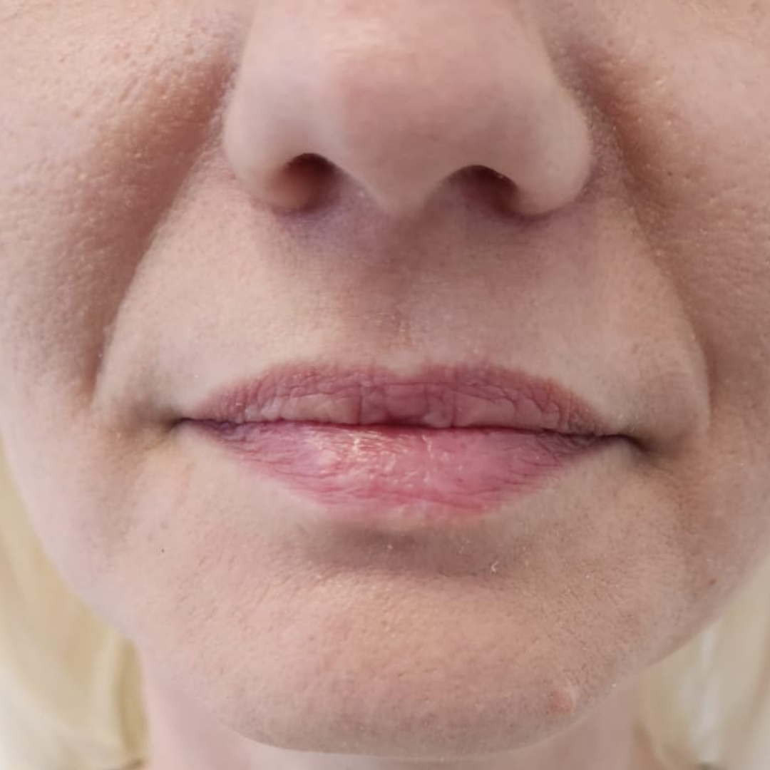 injectare acid hialuronic cluj inainte si dupa - Before