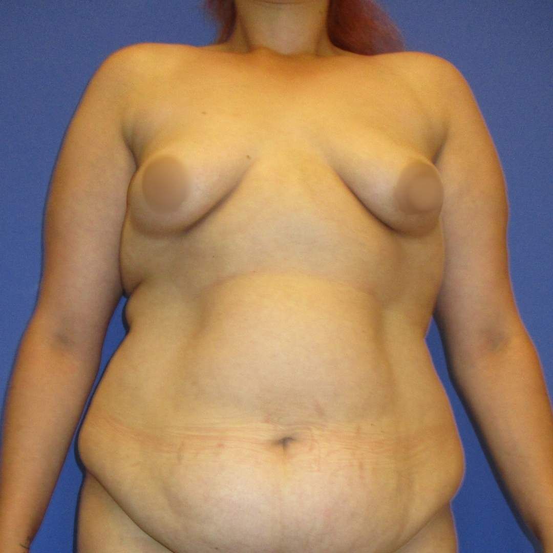 abdominoplastie - Before