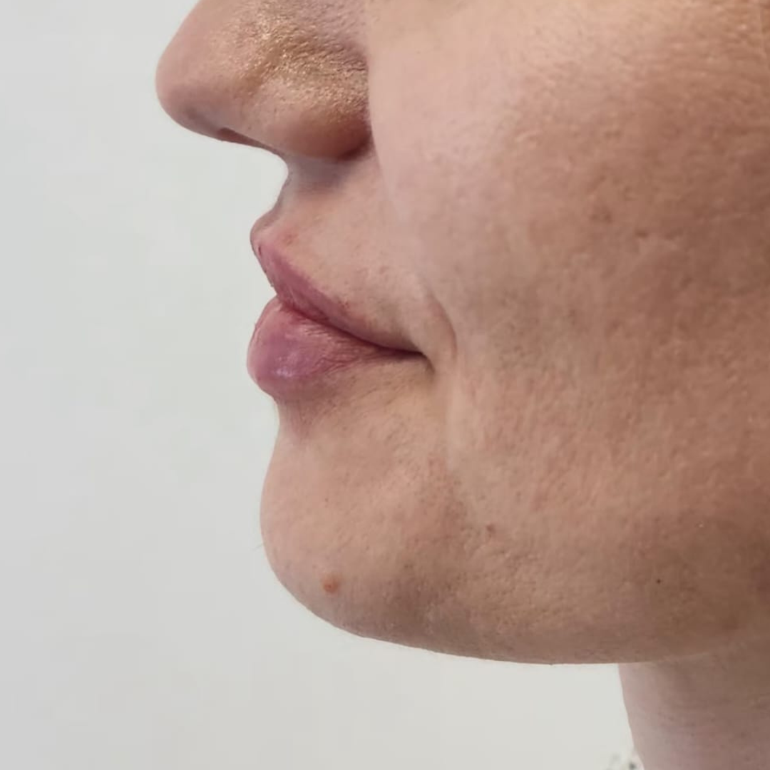 injectare acid hialuronic cluj before after - After