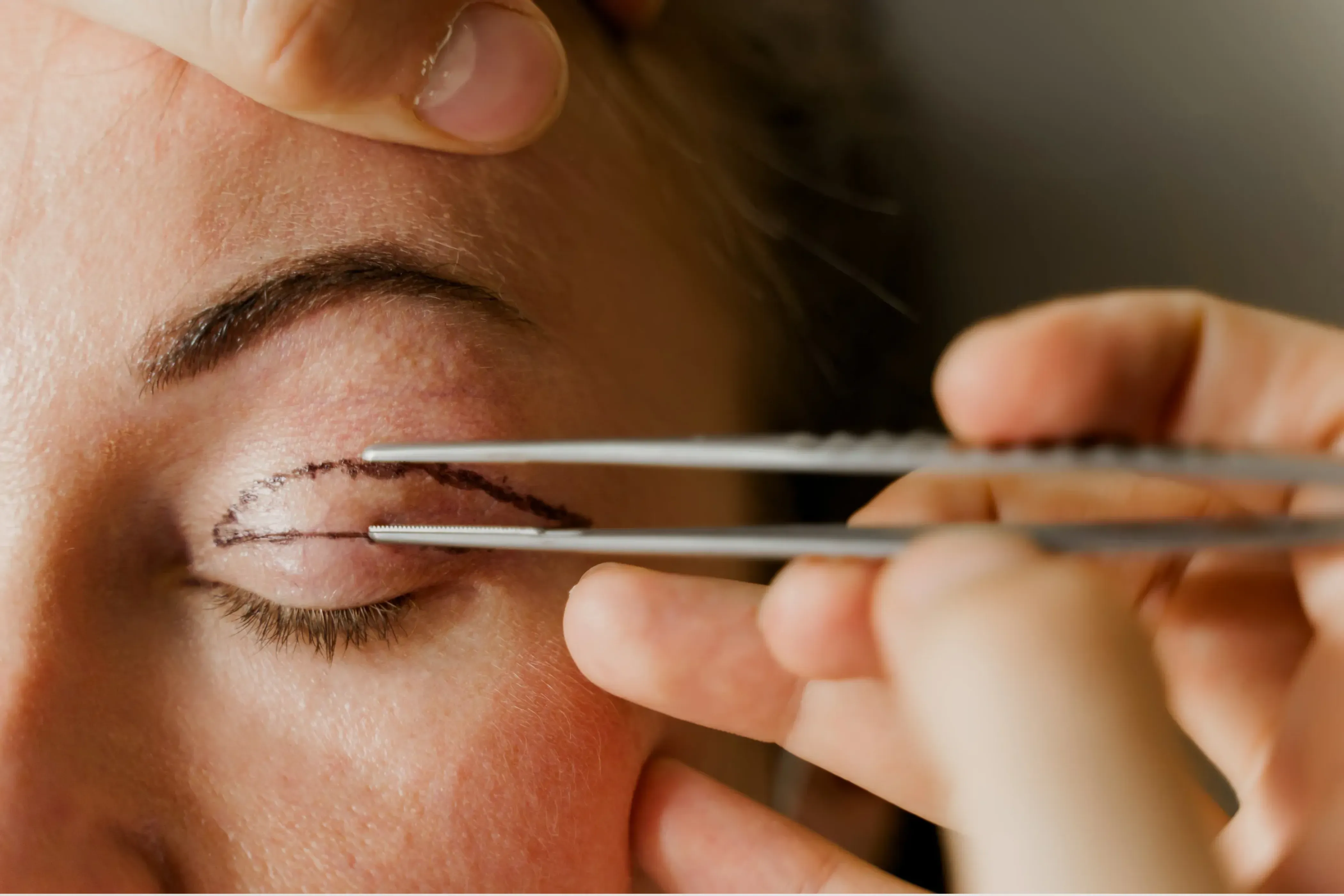 Blefaroplastie superioară: recuperare zi cu zi și ce să te aștepți după operație