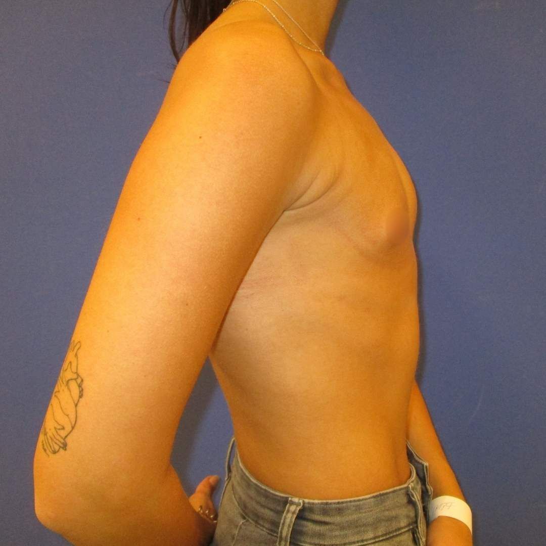 implant mamar inainte si dupa - Before
