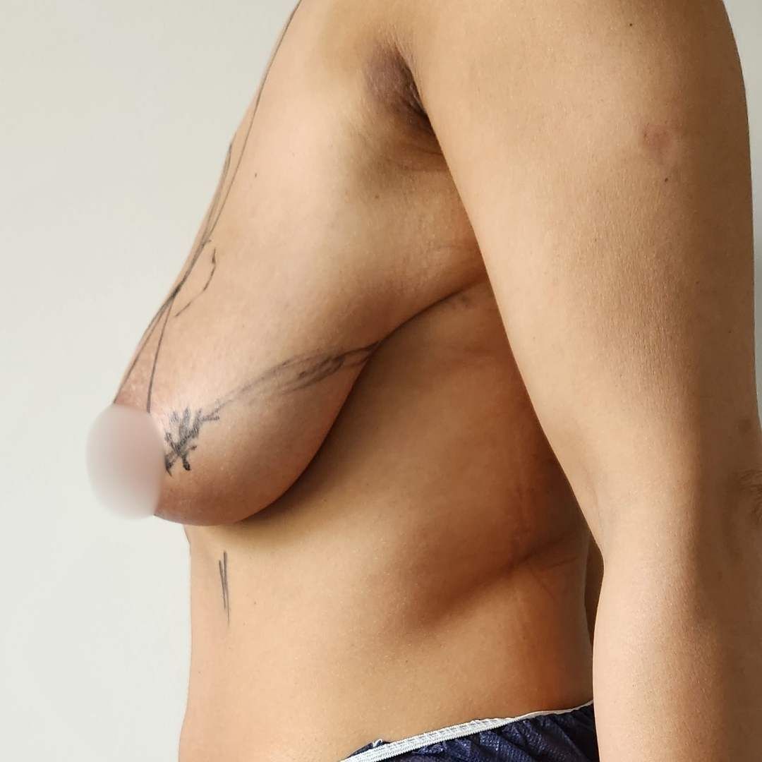mamoplastie - Before