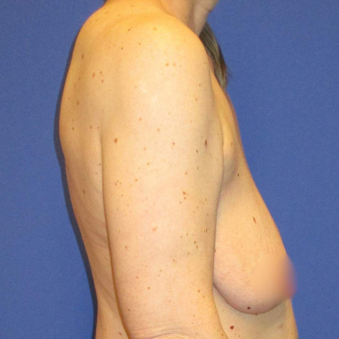 mastopexia - Before