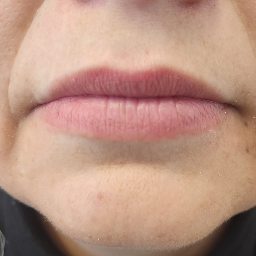 injectare acid hialuronic before after - Before